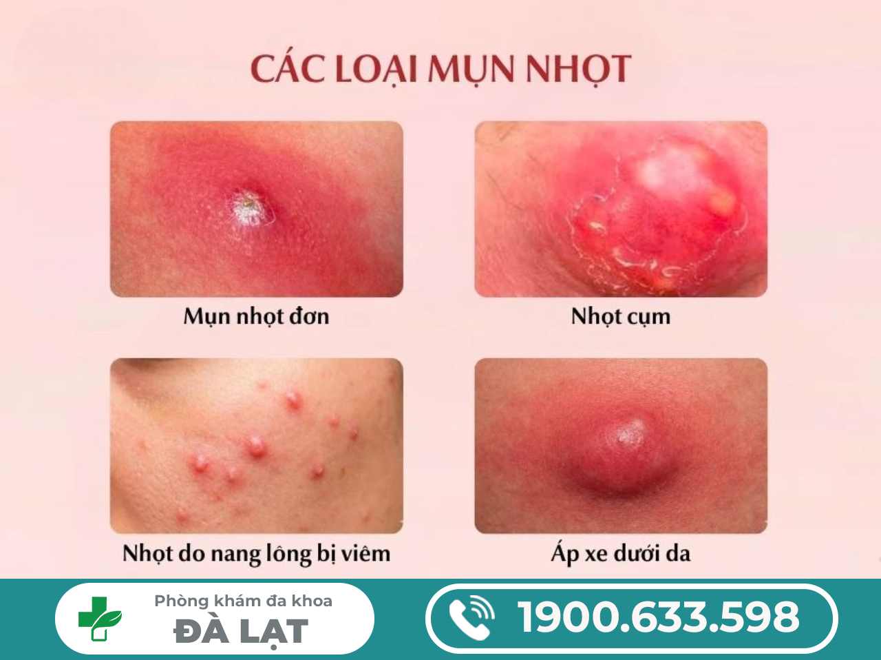 Hình ảnh minh họa